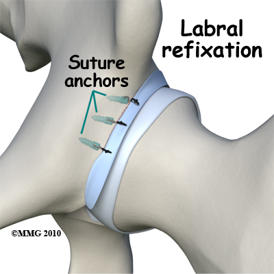 Labral refixation